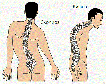 Сколиоз причины