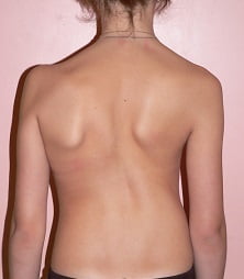 Сколиоз признаки