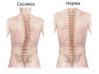 Сколиоз симптомы