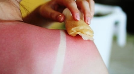 Солнечный ожог чем мазать