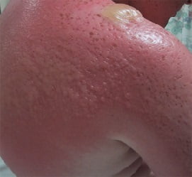 Солнечный ожог лечение