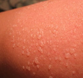 Солнечный ожог симптомы