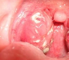 Тонзиллит признаки