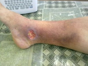 Трофическая язва на ноге лечение