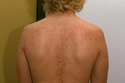 Трубчатый лишай лечение