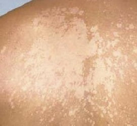 Трубчатый лишай