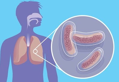 Туберкулез признаки