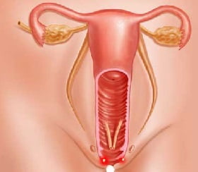 Уретрит у женщин лечение