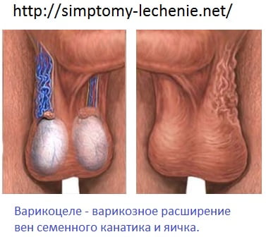 Варикоцеле