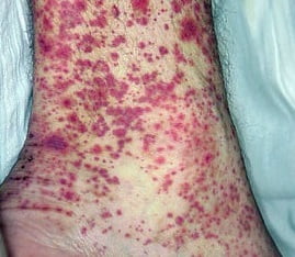 Васкулит на ноге