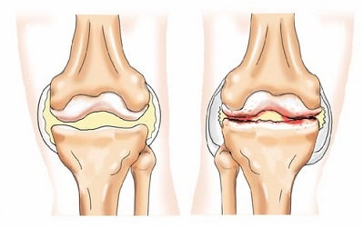 артроз коленного сустава симптомы