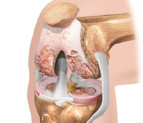артроз коленного сустава