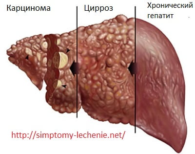 гепатит и цирроз