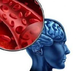 инсульт причины