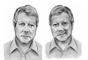 инсульт признаки