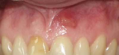 киста зуба признаки