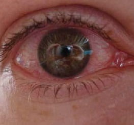 вирусный конъюнктивит 5