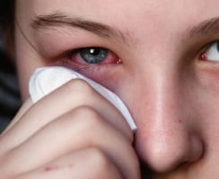 вирусный конъюнктивит