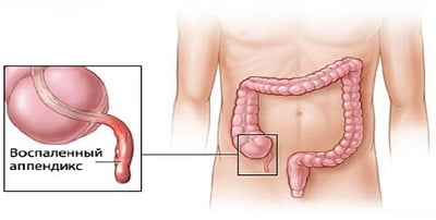 воспаленный Аппендицит