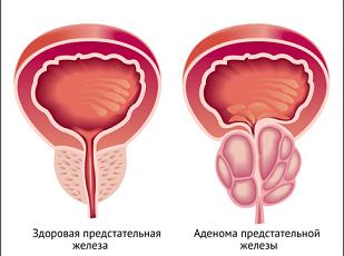 Аденома простаты