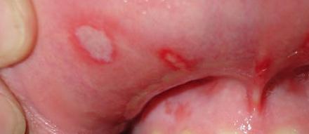 Афтозный стоматит лечение