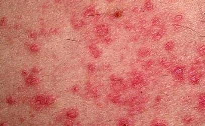 Аллергический дерматит симптомы