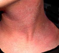 Аллергический дерматит