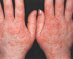 Аллергия на холод симптомы