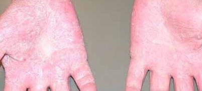 Аллергия на холод