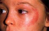 Аллергия на солнце признаки