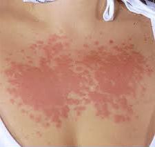 Аллергия на солнце симптомы