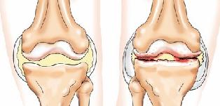 Артроз признаки