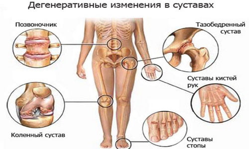 Артроз симптомы