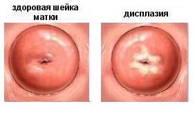 Дисплазия шейки матки фото