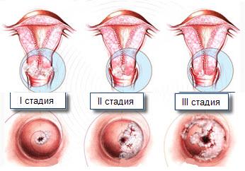 Дисплазия шейки матки симптомы