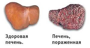 Гепатит С печень