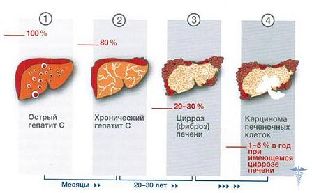 Гепатит С прогноз