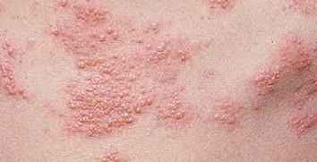 Герпес на теле лечение