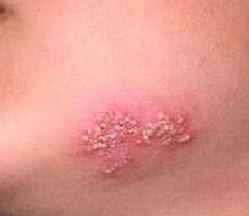 Герпес на теле симптомы