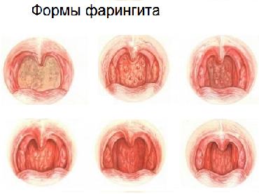Хронический фарингит причины