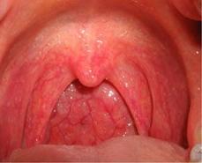 Хронический фарингит симптомы