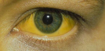 Хронический гепатит