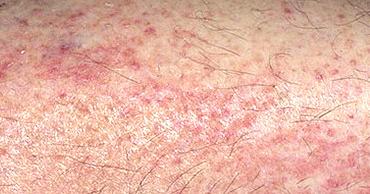 Экзема на ногах лечение