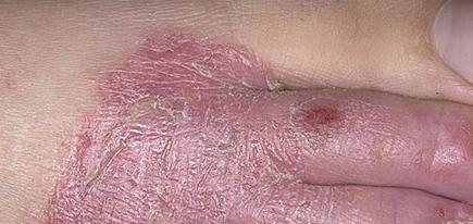 Экзема на ногах симптомы