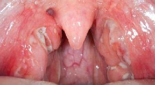 Лакунарная ангина симптомы