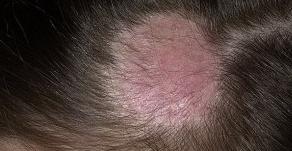 Лишай у человека