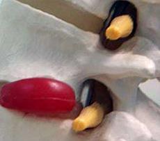 Межпозвоночная грыжа лечение