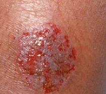 Микробная экзема