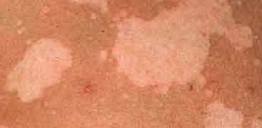 Солнечный лишай лечение