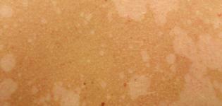 Солнечный лишай симптомы